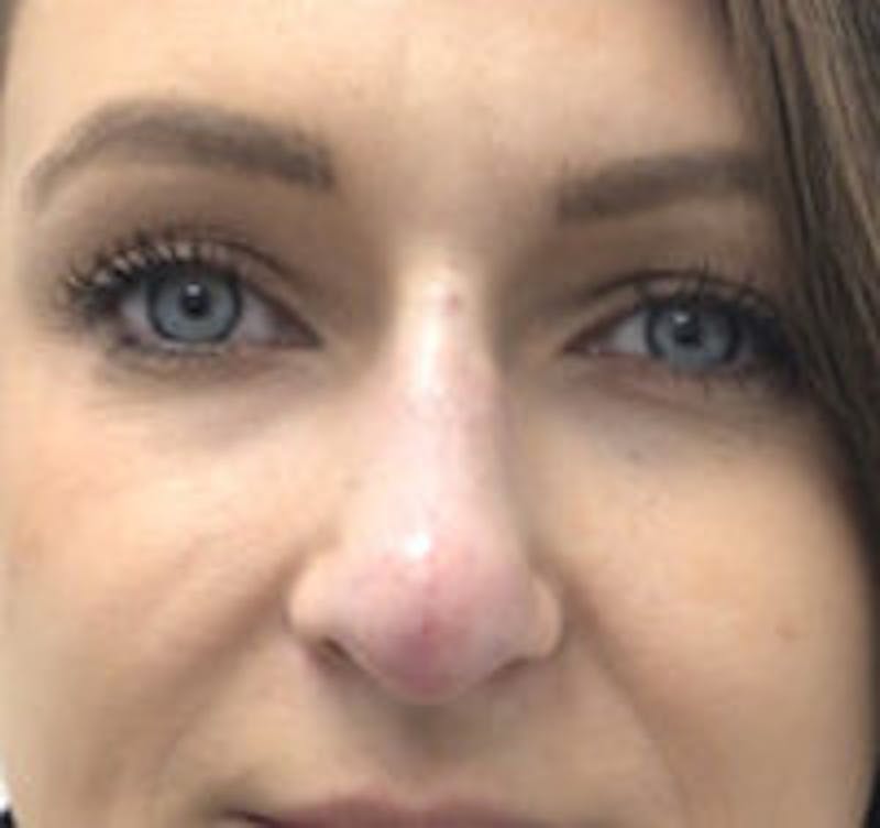 Non-Surgical Rhinoplasty / Nose Filler Before & After Gallery - Patient 157140618 - Image 2