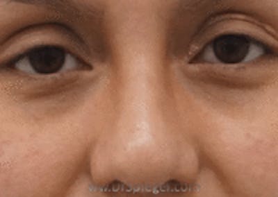 Rhinoplasty Before & After Gallery - Patient 157140614 - Image 2