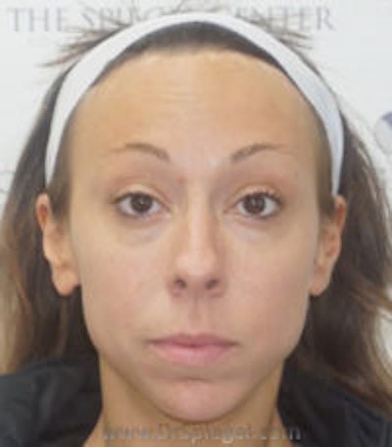 Scalp Advancement Before & After Gallery - Patient 157140617 - Image 2