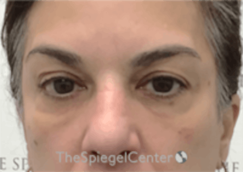 Temple Filler Before & After Gallery - Patient 157140615 - Image 2