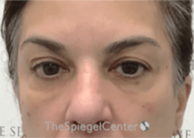 Temple Filler Before & After Gallery - Patient 157140615 - Image 2