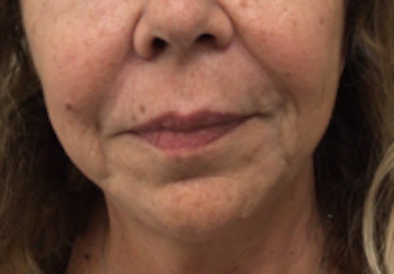 Nasolabial Fold Filler Before & After Gallery - Patient 157140627 - Image 1