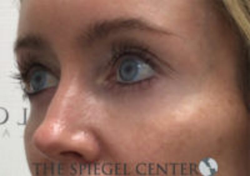 Tear Trough / Under Eye Fillers Before & After Gallery - Patient 157140616 - Image 4