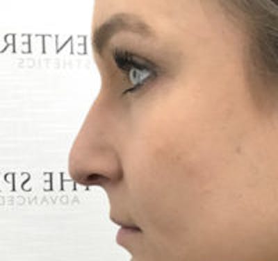 Non-Surgical Rhinoplasty / Nose Filler Before & After Gallery - Patient 157140618 - Image 3