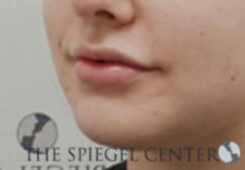Lip Filler Before & After Gallery - Patient 157140619 - Image 6