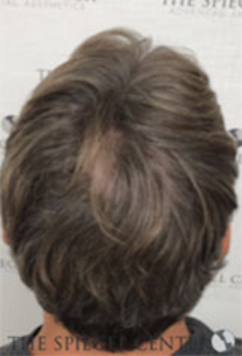 Hair Restoration Before & After Gallery - Patient 157140624 - Image 2