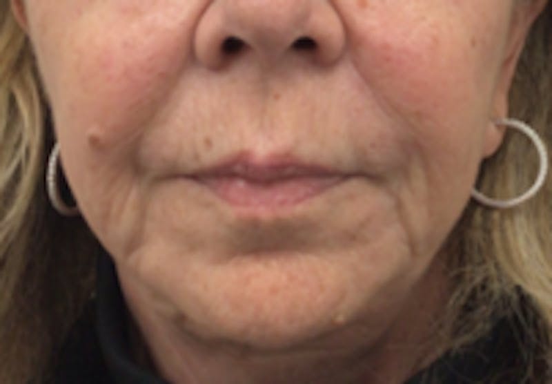 Nasolabial Fold Filler Before & After Gallery - Patient 157140627 - Image 2