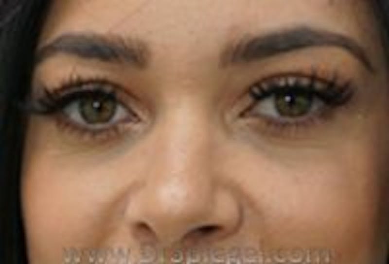 Tear Trough / Under Eye Fillers Before & After Gallery - Patient 157140628 - Image 1