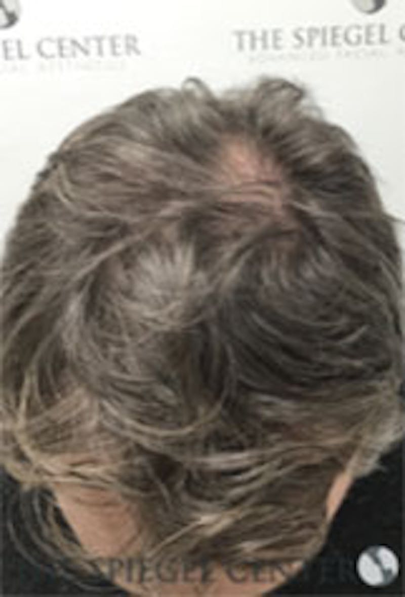 Hair Restoration Before & After Gallery - Patient 157140624 - Image 3