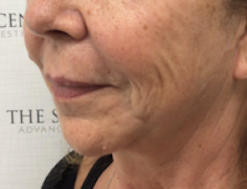 Nasolabial Fold Filler Before & After Gallery - Patient 157140627 - Image 3