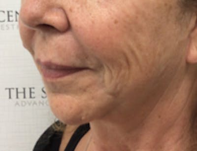 Nasolabial Fold Filler Before & After Gallery - Patient 157140627 - Image 3