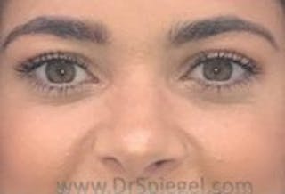 Tear Trough / Under Eye Fillers Before & After Gallery - Patient 157140628 - Image 2