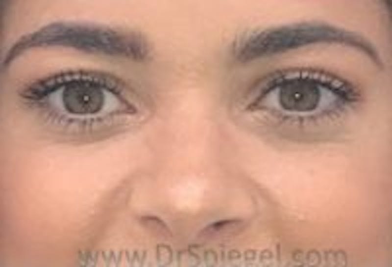 Tear Trough / Under Eye Fillers Before & After Gallery - Patient 157140628 - Image 2