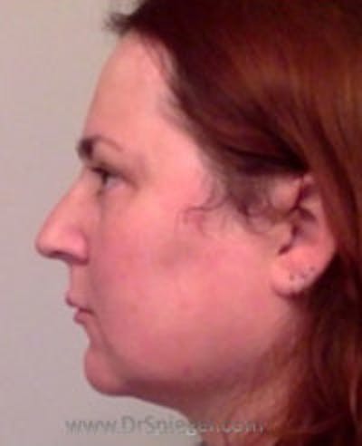 Scalp Advancement Before & After Gallery - Patient 157140626 - Image 1
