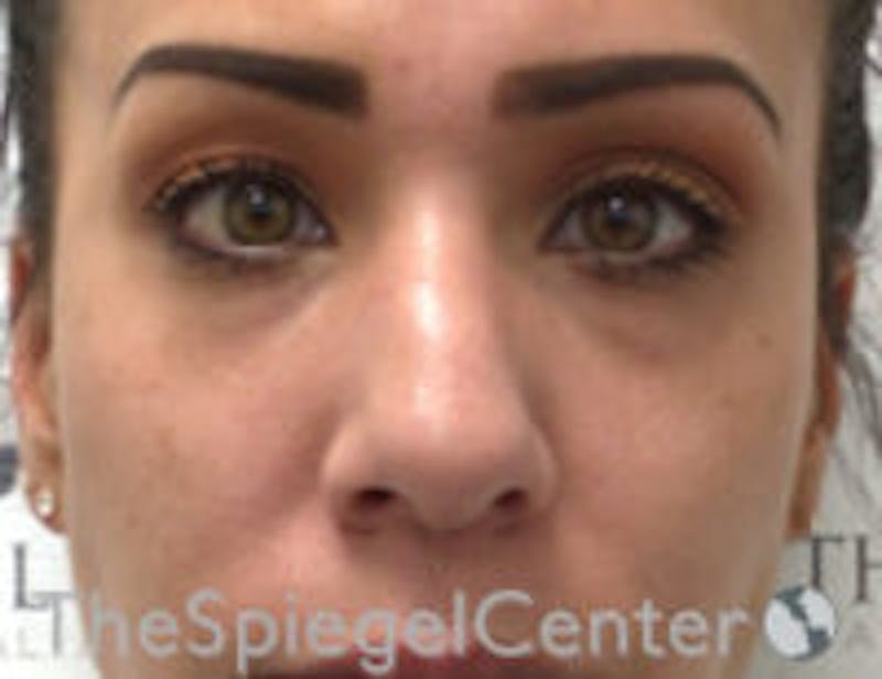 Non-Surgical Rhinoplasty / Nose Filler Before & After Gallery - Patient 157140631 - Image 1