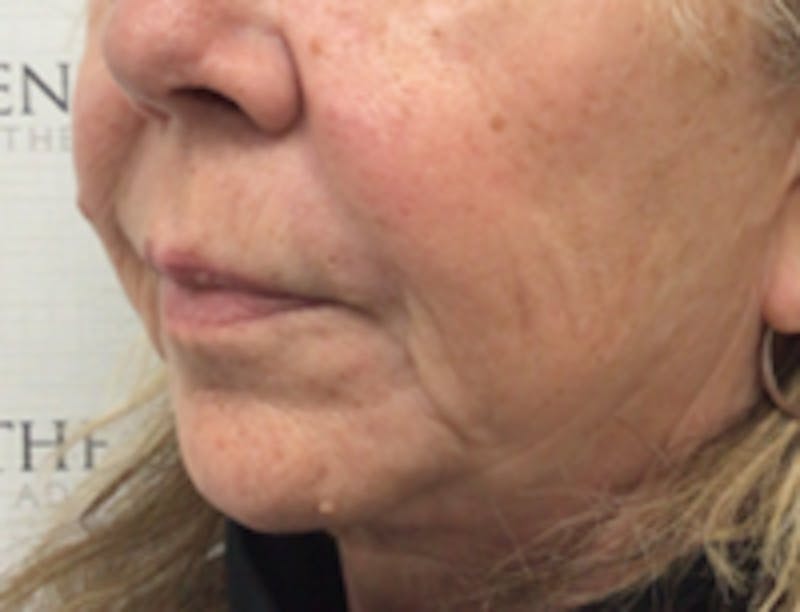 Nasolabial Fold Filler Before & After Gallery - Patient 157140627 - Image 4