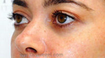 Tear Trough / Under Eye Fillers Before & After Gallery - Patient 157140628 - Image 3