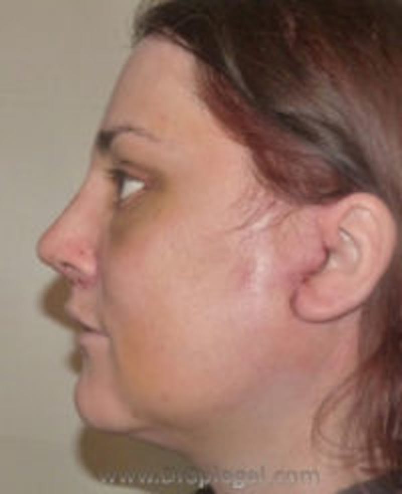 Scalp Advancement Before & After Gallery - Patient 157140626 - Image 2