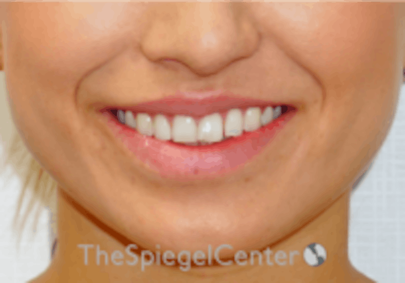 Lip Filler Before & After Gallery - Patient 157140638 - Image 2