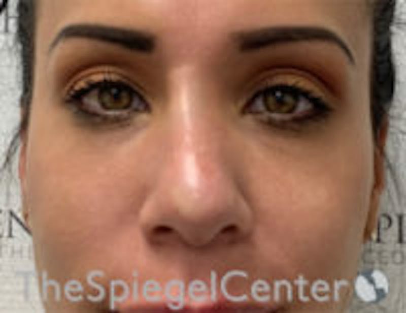 Non-Surgical Rhinoplasty / Nose Filler Before & After Gallery - Patient 157140631 - Image 2