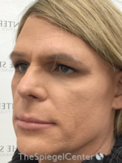 FFS Before & After Gallery - Patient 157140632 - Image 1