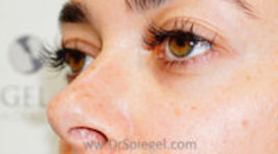 Tear Trough / Under Eye Fillers Before & After Gallery - Patient 157140628 - Image 4