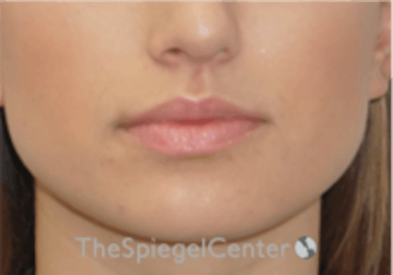 Lip Filler Before & After Gallery - Patient 157140638 - Image 3