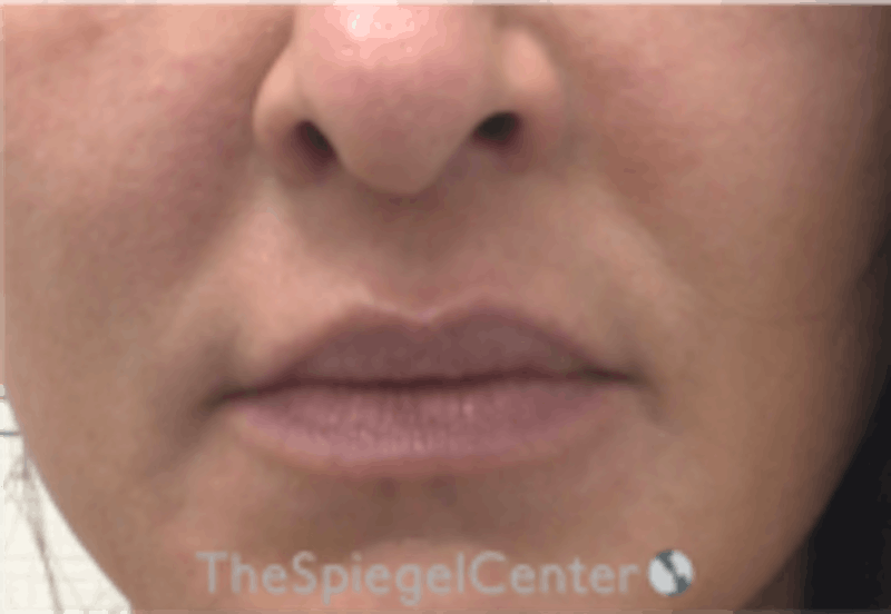 Nasolabial Fold Filler Before & After Gallery - Patient 157140641 - Image 1