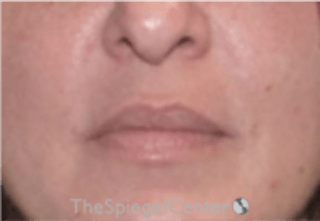 Nasolabial Fold Filler Before & After Gallery - Patient 157140641 - Image 2