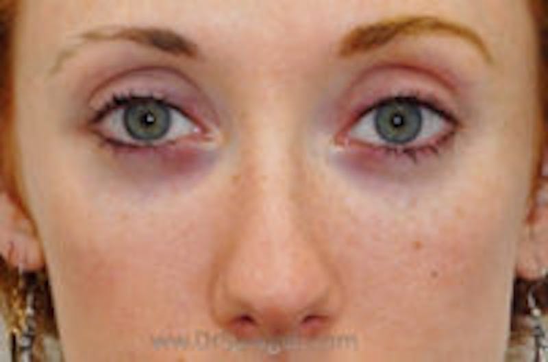 Tear Trough / Under Eye Fillers Before & After Gallery - Patient 157140640 - Image 2