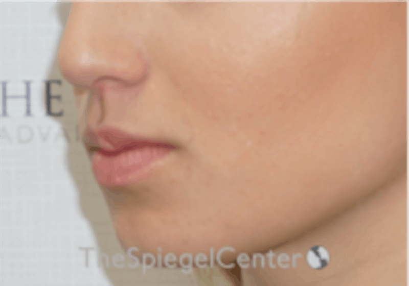 Lip Filler Before & After Gallery - Patient 157140638 - Image 5