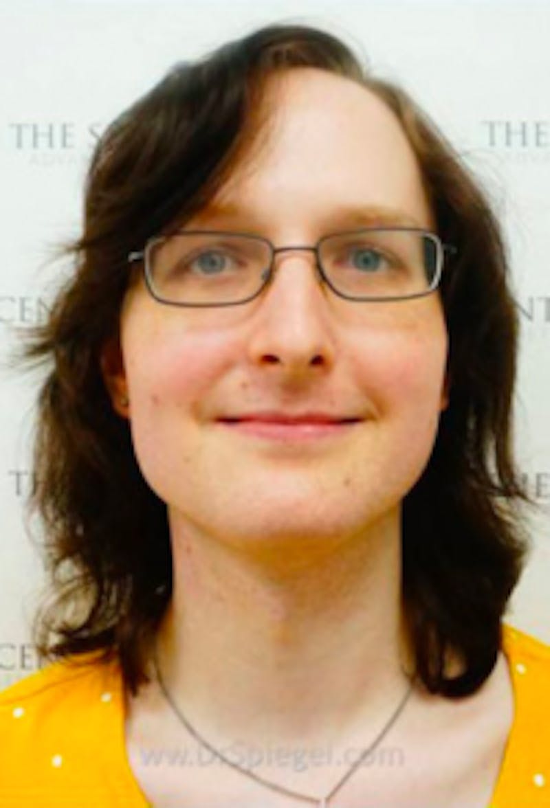 FFS Before & After Gallery - Patient 157140639 - Image 1
