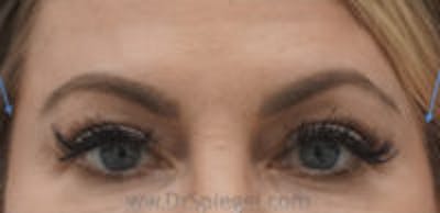 Temple Filler Before & After Gallery - Patient 157140635 - Image 2