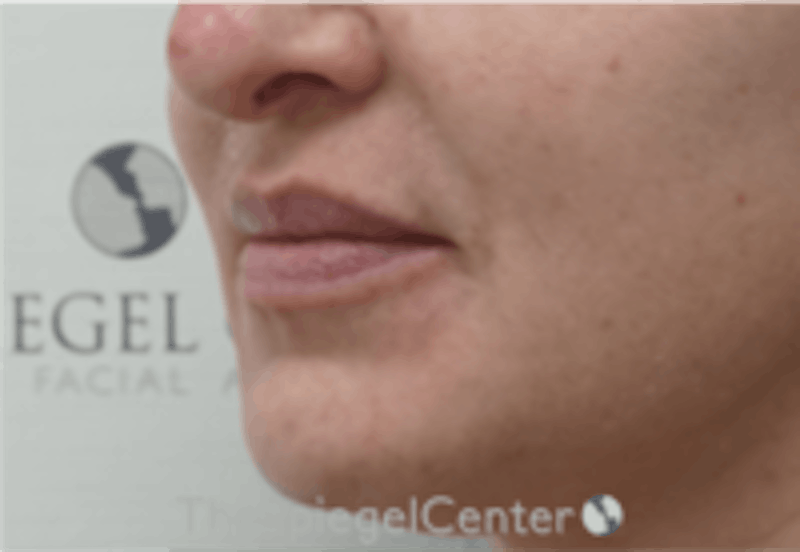 Nasolabial Fold Filler Before & After Gallery - Patient 157140641 - Image 3