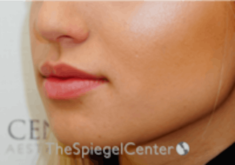 Lip Filler Before & After Gallery - Patient 157140638 - Image 6