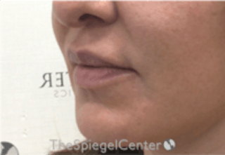 Nasolabial Fold Filler Before & After Gallery - Patient 157140641 - Image 4