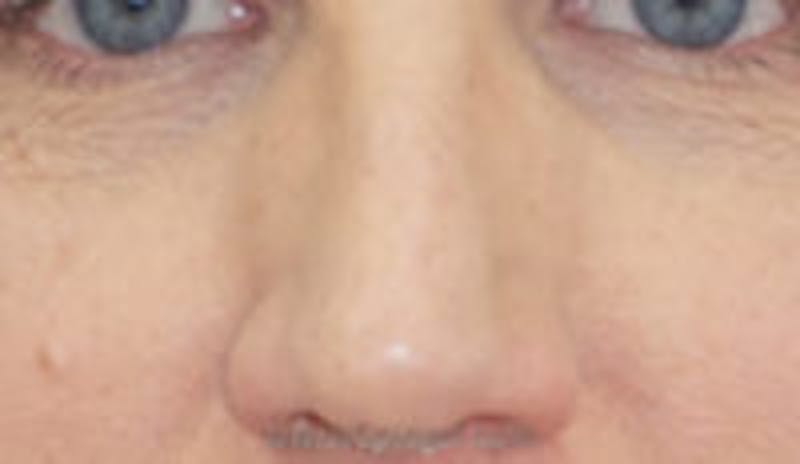 Rhinoplasty Before & After Gallery - Patient 157140645 - Image 1