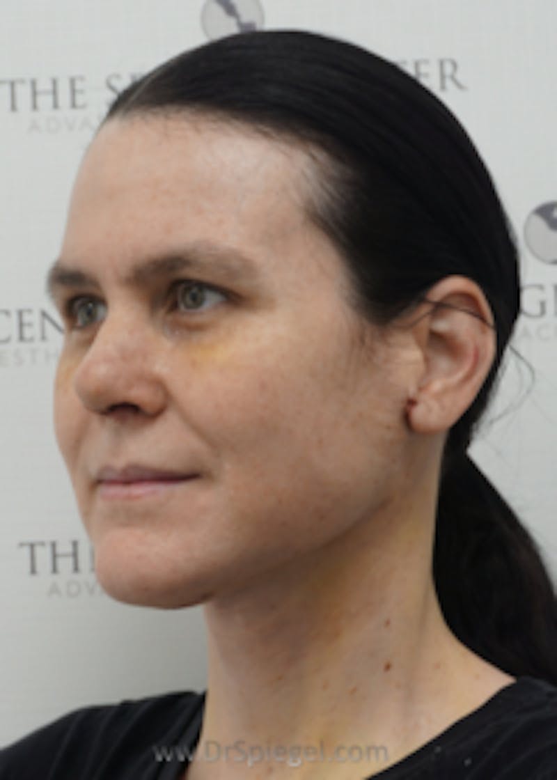 FFS Before & After Gallery - Patient 157140649 - Image 1