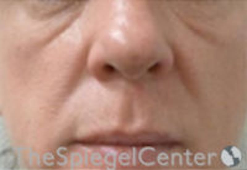 Nasolabial Fold Filler Before & After Gallery - Patient 157140653 - Image 1