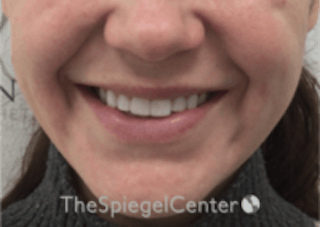 Lip Filler Before & After Gallery - Patient 157140658 - Image 2