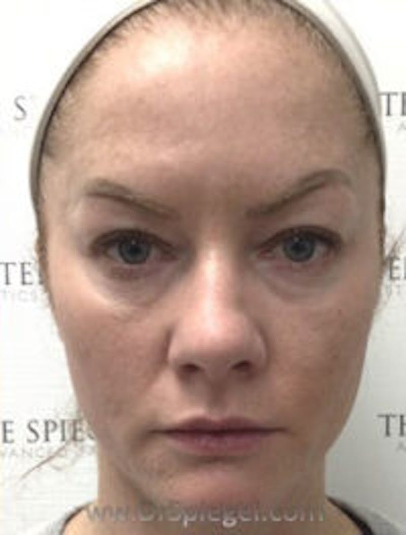 Botox / Dysport / Jeuveau / Xeomin Before & After Gallery - Patient 157140647 - Image 4