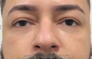 Tear Trough / Under Eye Fillers Before & After Gallery - Patient 157140650 - Image 2