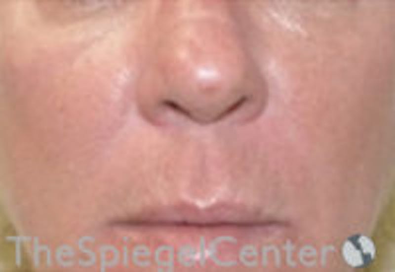 Nasolabial Fold Filler Before & After Gallery - Patient 157140653 - Image 2