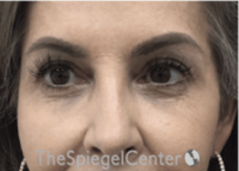 Temple Filler Before & After Gallery - Patient 157140651 - Image 1