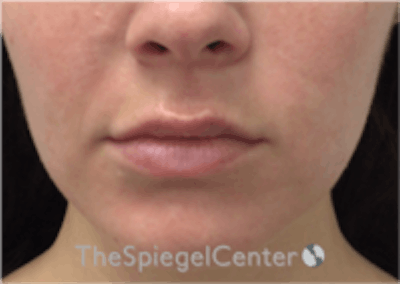 Lip Filler Before & After Gallery - Patient 157140658 - Image 3