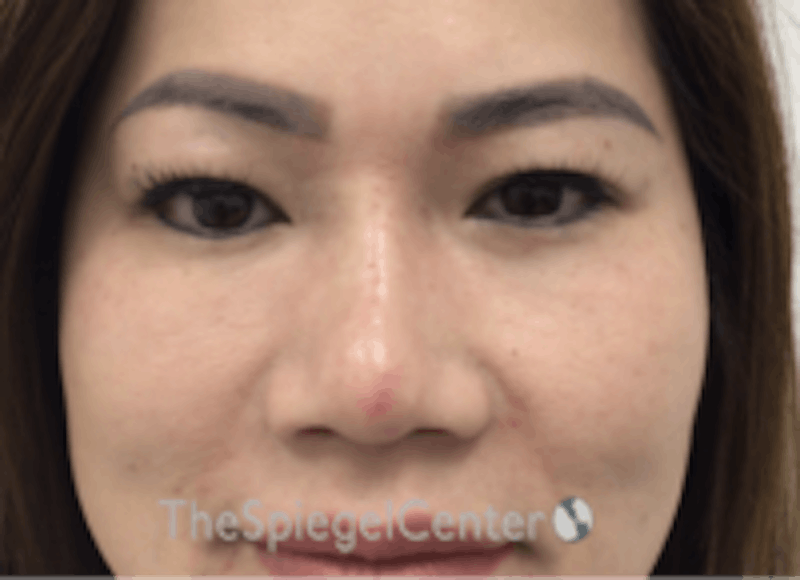 Non-Surgical Rhinoplasty / Nose Filler Before & After Gallery - Patient 157140656 - Image 2