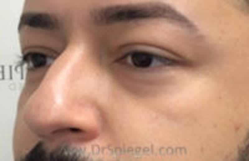Tear Trough / Under Eye Fillers Before & After Gallery - Patient 157140650 - Image 3