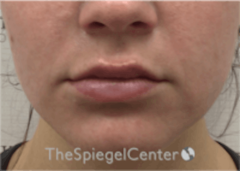 Lip Filler Before & After Gallery - Patient 157140658 - Image 4