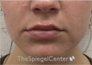 Lip Filler Before & After Gallery - Patient 157140658 - Image 4