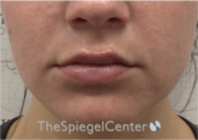 Lip Filler Before & After Gallery - Patient 157140658 - Image 4
